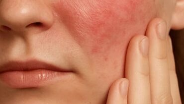Tratamiento Facial: Actividad regeneradora de la barrera cutanea