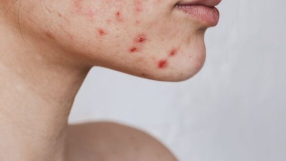 Tratamiento Facial: La OBSTRUCCIÓN FOLICULAR, Tratar y mejorar el ACNÉ ADOLESCENTE