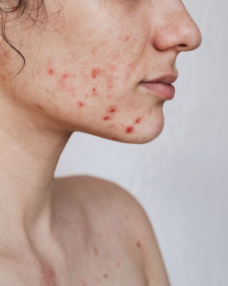 Tratamiento Facial: La OBSTRUCCIÓN FOLICULAR, Tratar y mejorar el ACNÉ ADOLESCENTE