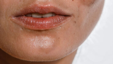Tratamiento Facial: Mejora manchas en 21 días