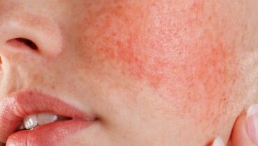 Tratamiento Facial: Protección de la Barrera Cutanea