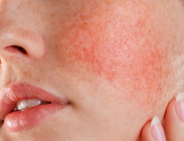 Tratamiento Facial: Protección de la Barrera Cutanea