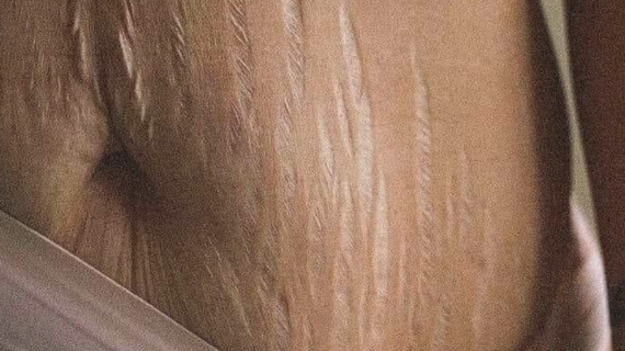 Tratamiento Corporal: ESTRÍAS & CELULITIS