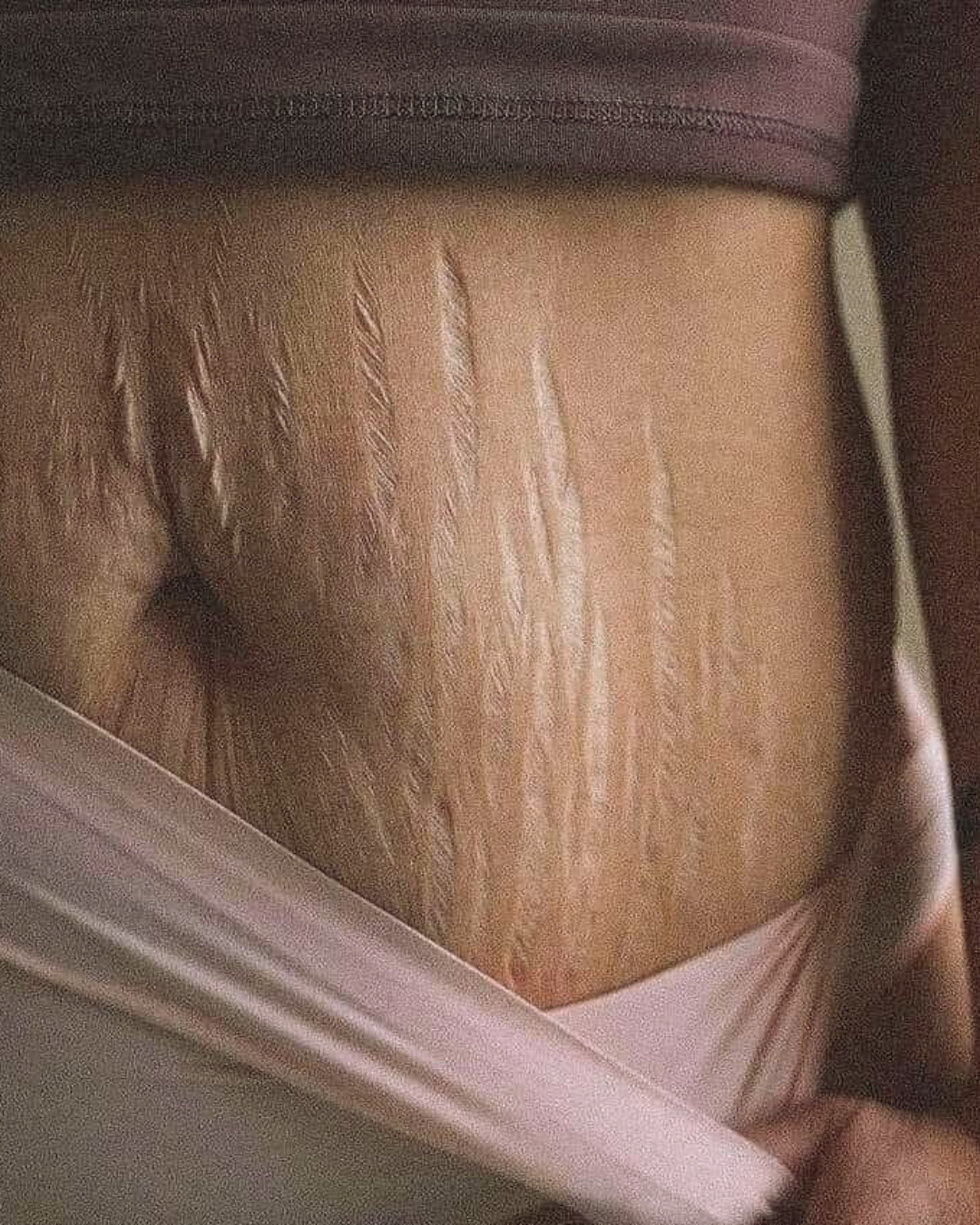 Tratamiento Corporal: ESTRÍAS & CELULITIS