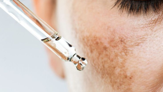 Tratamiento Facial: ACLARA MANCHAS DE LA PIEL